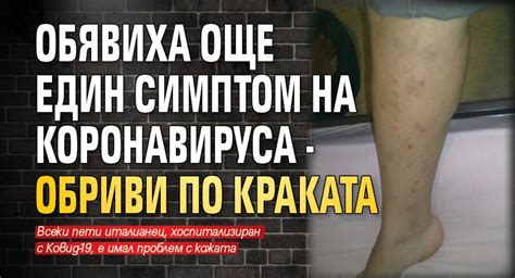 Обявиха още един симптом на коронавируса - обриви по краката - Lupa BG