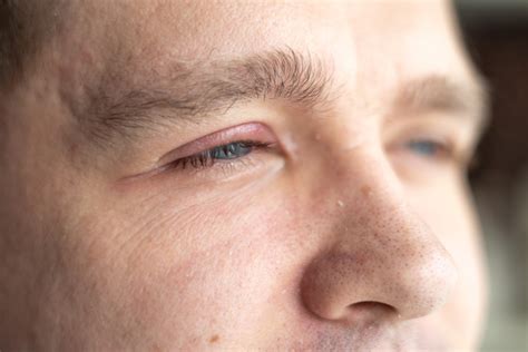 Managing Blepharitis: Home Remedies and Professional Treatments