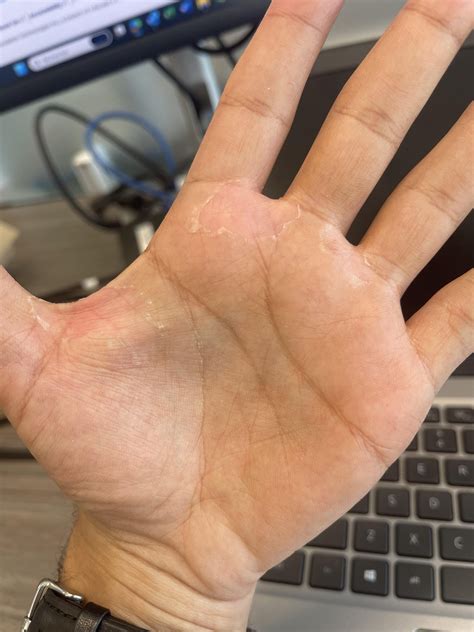 Is this exfoliative keratolysis? : r/ExfoliativeKera