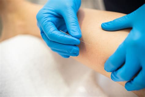 dry needling  acupuncture main differences  similarities