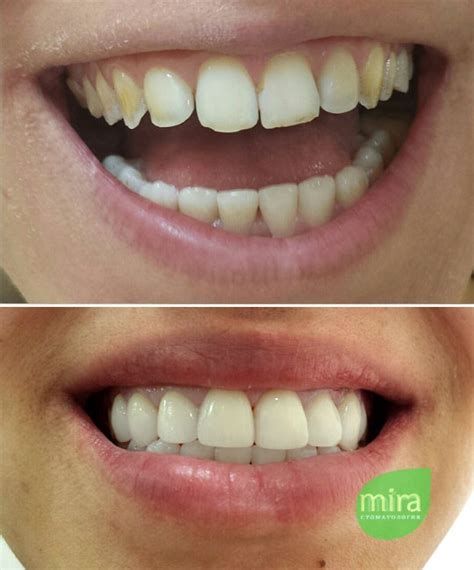 Эстетическая реставрация зубов - Стоматологическая клиника Mira