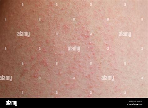 View 24 Allergic Reaction Skin Bumps