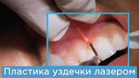 Френэктомия (пластика уздечки диодным лазером Biolase Epic). Как ...