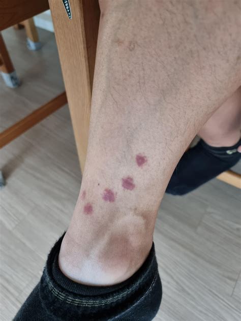 Bite Marks On Foot at Jessie Ramirez blog