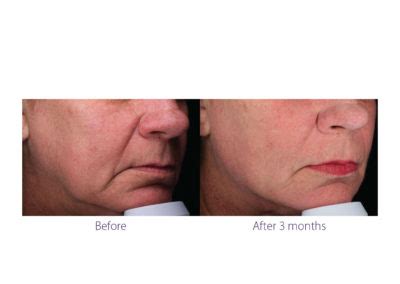 Beautifill Liposuction in Pensacola, FL | Ageless Pensacola