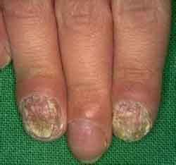 Resultaten behandeling candida