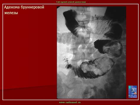 ПС. Опухоли двенадцатиперстной кишки. + | Портал радиологов