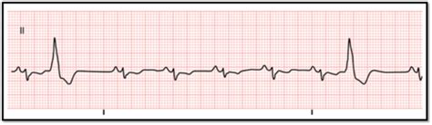 Ventricular rhythms Flashcards | Quizlet