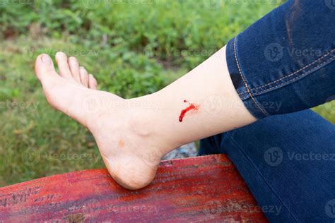 Woman bleed at Leg From Leech After Trekking in Forest 16263377 Stock ...