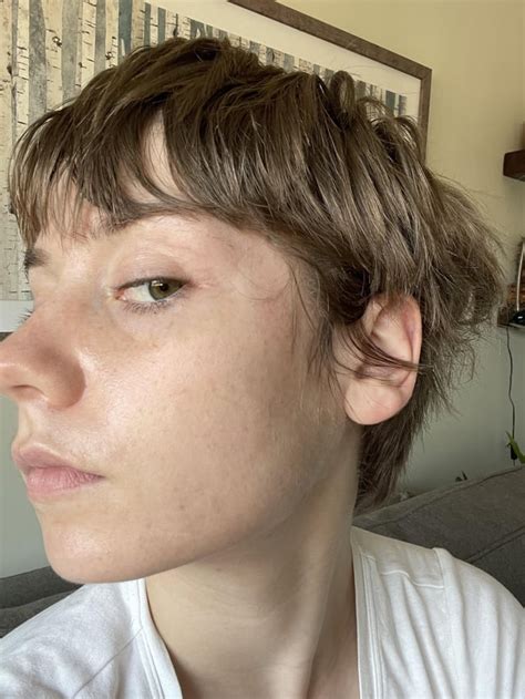[Before&After] [Selfie] 4 Words: Spearmint MF Tea : r/SkincareAddiction