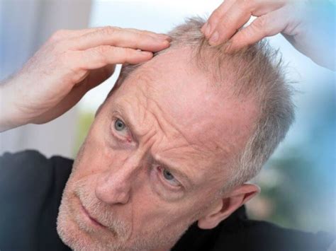 scalp care  men  hair sharpologist