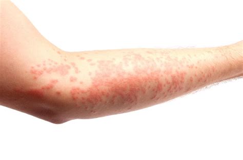 What Allergies Causes Rashes | Global Healthcare