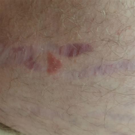 Itchy spots on inner thighs have turned into horrible rashes. Doctor
