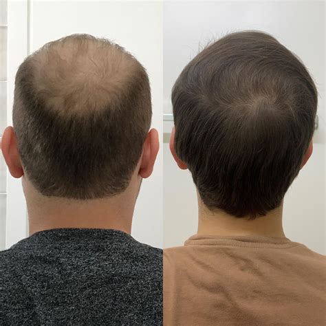 Finasteride/Dutasteride possible side effects on brain health : r/tressless