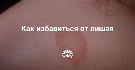Как быстро избавиться от лишая на теле | WDAY