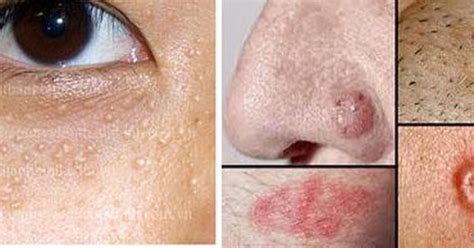 Những nguyên nhân gây mụn cóc trên mặt và cách điều trị hiệu quả