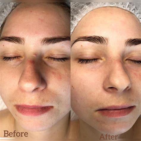 Face before and after the... - Zina Beauty & Aesthetics
