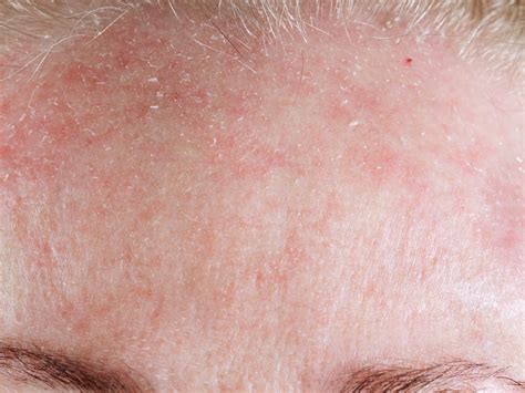 how to get rid of redness of face 2