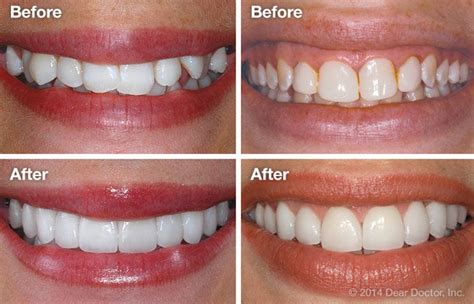 veneers before and after crooked teeth