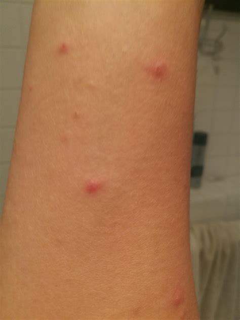 Itchy Skin Bumps