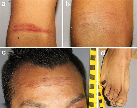 The photographs taken at the autopsy: multiple superficial cut wounds ...