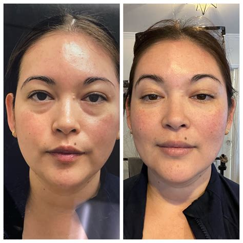 First Experience: injection treatments - Sonderbeaut