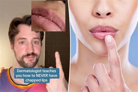 eliminating chapped lips  dermatologists  step regimen