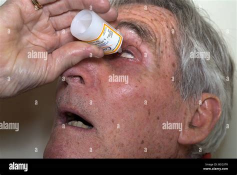 Applying eye drops to treat cataracts Stock Photo - Alamy