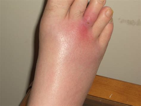 MRSA Infection | Flickr