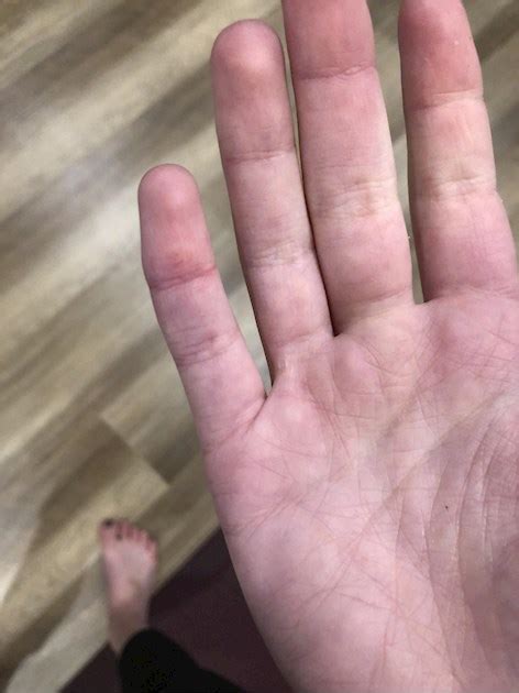 hard bumpnodule  pinky nras healthunlocked