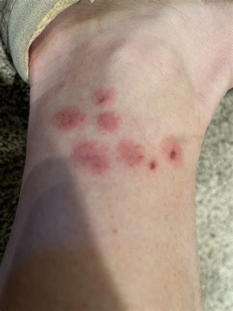 ankle bit 1 week ago. looks like 2 punctures in bites. only place