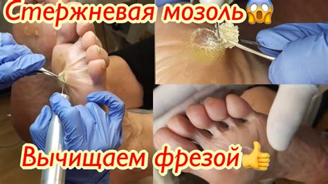 Как выглядит стержневая мозоль на пятке фото