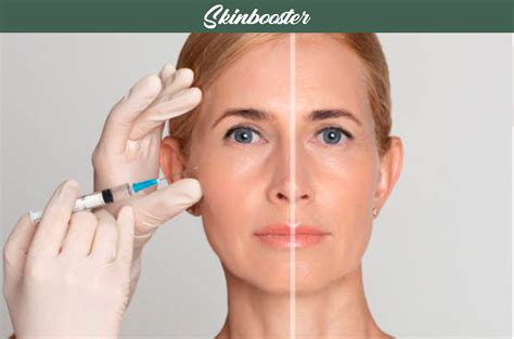 Skinbooster O Que É - Skinbooster Injentavel - Veja Skinbooster Antes e Depois!