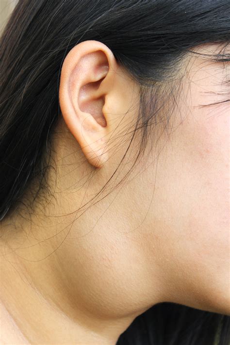 Cyst On Side Of Neck