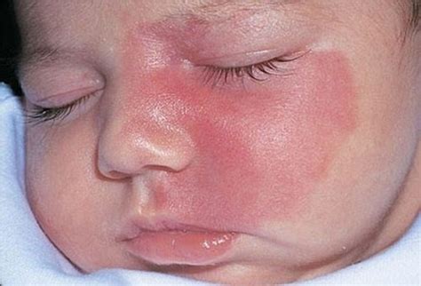Congenital hemangiomas need treatment? | Vinmec