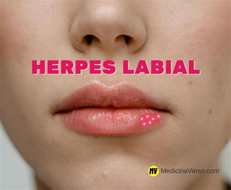 Herpes Bucal Como Pega - Como se Pega Sarna Humana: Informações Importantes para se Prevenir e ...