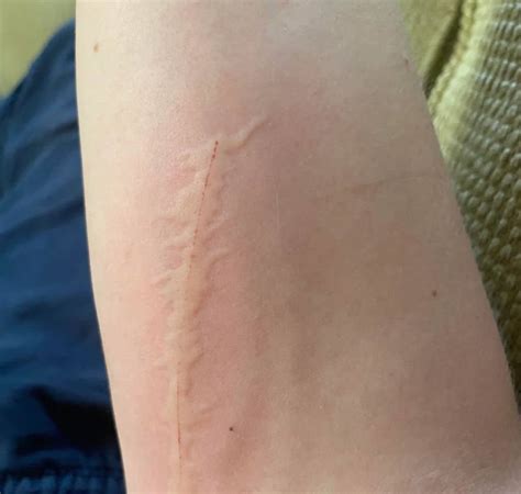 heal cat scratches fast fastest ways  heal cat scratches