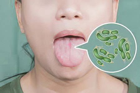 Glossitis: types, symptoms and treatment – Healthy Food Near Me