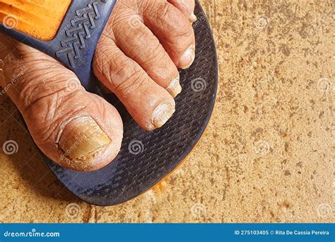 Ugly Toes Of A Girl With A Fungus And Ingrown Toenails Stock Photo ...