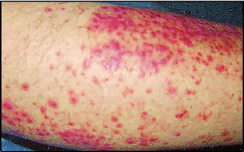 An Unusual Initial Manifestation of Acute Leukemia - The American ...