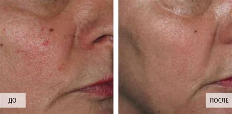 Удаление купероза на лице аппаратом М22 | Premium Aesthetics