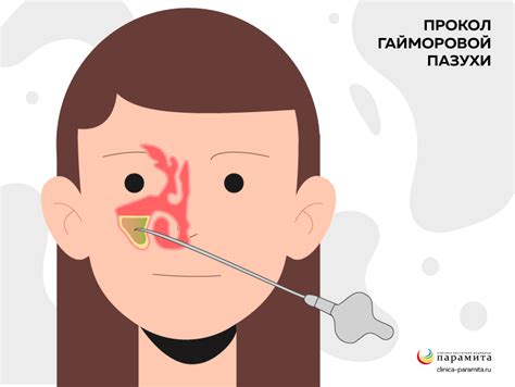 Катаральный гайморит: причины, симптомы и лечение