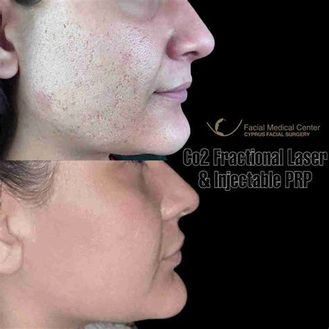 fractional laser cyprus facial surgery