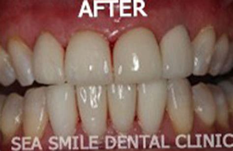 Bangkok Dental - Dentist by Bangkok Smile Dental Clinic in Thailand