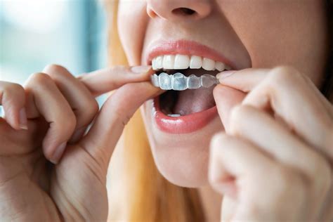 Does Invisalign Fix Overbite? How It Works & Benefits - Wyndham Dental