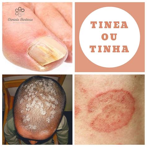 Doenças De Pele Causada Por Fungo - Dra. - Doença causada por fungos chamados de dermatófitos. Estes fungos ...