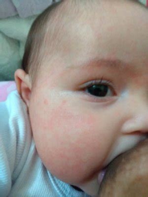 Bebe Com Rosto Vermelho - Rosto do bebê vermelho após banho ajuda | BabyCenter