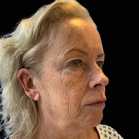 London Plastic surgeon stem cell facelift surgery