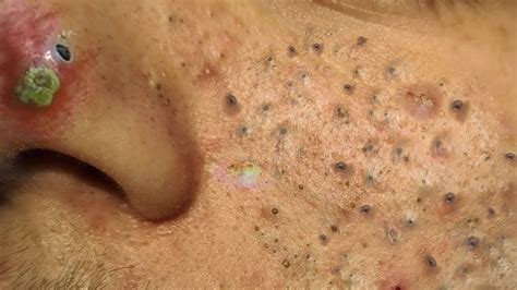 Blackhead Removal With Sac Dep Spa @1000673 - YouTube