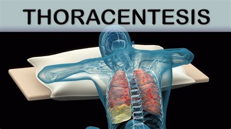 Thoracentesis Medical Animation - YouTube